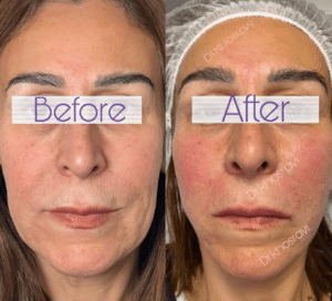 نمونه لیفت با نخ دکتر حسین خسروی