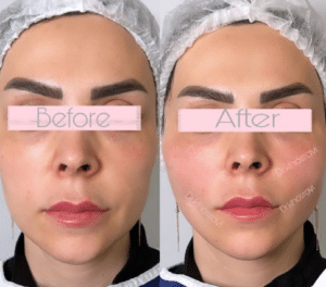 نمونه لیفت با نخ دکتر حسین خسروی