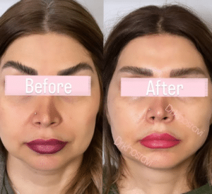 نمونه لیفت با نخ دکتر حسین خسروی