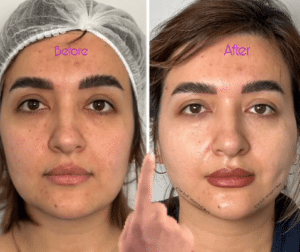 نمونه لیفت با نخ دکتر حسین خسروی