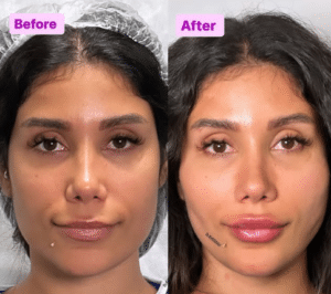 نمونه لیفت با نخ دکتر حسین خسروی