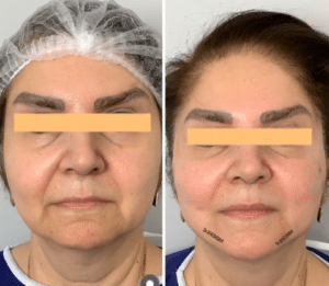 نمونه لیفت با نخ دکتر حسین خسروی