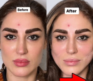 نمونه لیفت با نخ دکتر حسین خسروی