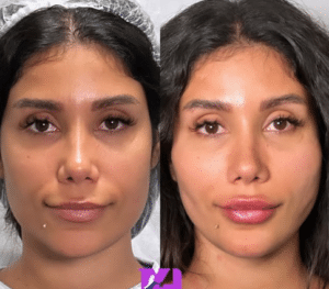 نمونه لیفت با نخ دکتر حسین خسروی