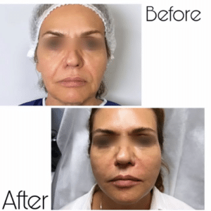 نمونه لیفت با نخ دکتر حسین خسروی