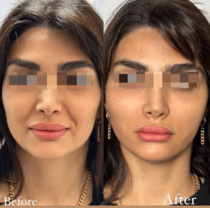 نمونه لیفت با نخ دکتر حسین خسروی