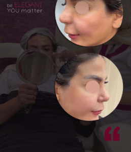 نمونه لیفت صورت با نخ کلینیک زیبایی الگانت