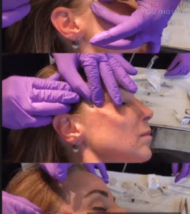 نمونه لیفت صورت با نخ کلینیک زیبایی الگانت