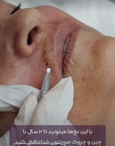 نمونه لیفت صورت با نخ کلینیک زیبایی الگانت