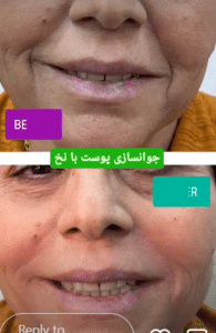 نمونه لیفت صورت با نخ کلینیک زیبایی الگانت