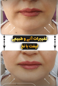 نمونه لیفت صورت با نخ کلینیک زیبایی الگانت