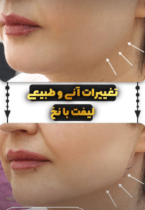 نمونه لیفت صورت با نخ کلینیک زیبایی الگانت