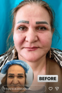 نمونه جراحی لیفت صورت دکتر امید اعتماد