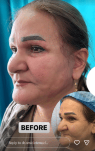 نمونه جراحی لیفت صورت دکتر امید اعتماد