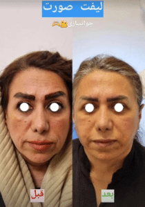 نمونه لیفت صورت دکتر علی اصغر اسفندیار