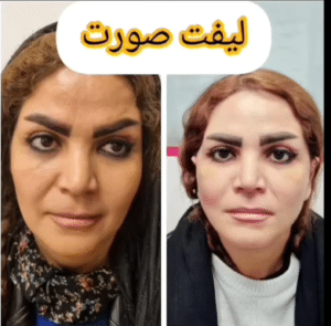 نمونه لیفت صورت دکتر علی اصغر اسفندیار