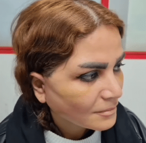 نمونه لیفت صورت دکتر علی اصغر اسفندیار