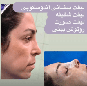 نمونه لیفت شقیقه دکتر احمد زاغی حسن زاده