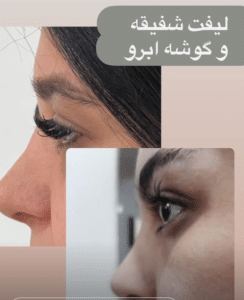 نمونه لیفت شقیقه دکتر احمد زاغی حسن زاده