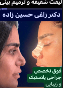 نمونه لیفت شقیقه دکتر احمد زاغی حسن زاده