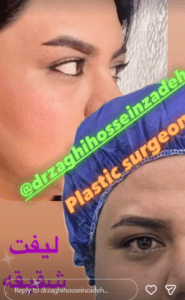 نمونه لیفت شقیقه دکتر احمد زاغی حسن زاده