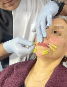 نمونه لیفت صورت دکتر محسن پور آریا