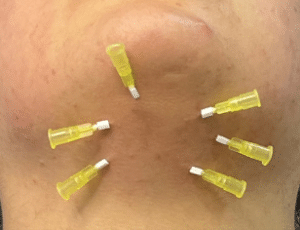 نمونه لیفت صورت دکتر محسن پور آریا