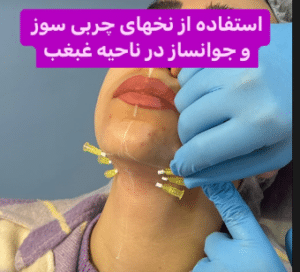 نمونه لیفت صورت دکتر محسن پور آریا