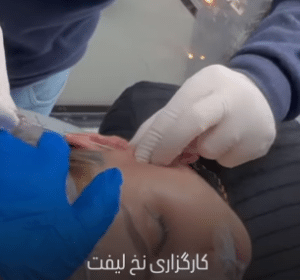 نمونه لیفت صورت کلینیک زیبایی کاژه