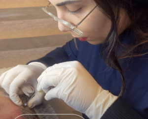 نمونه لیفت صورت با نخ دکتر سحر مروج