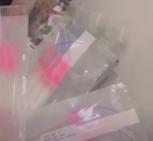 نمونه لیفت صورت با نخ دکتر سحر مروج