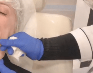 نمونه لیفت صورت با نخ دکتر سحر مروج