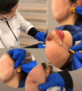 نمونه لیفت صورت با نخ دکتر سحر مروج