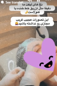 نمونه لیفت صورت با نخ دکتر سحر مروج