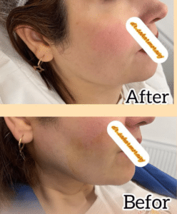 نمونه لیفت صورت با نخ دکتر سحر مروج