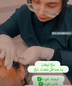 نمونه لیفت صورت با نخ دکتر سحر مروج