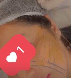 نمونه لیفت صورت با نخ دکتر سحر مروج