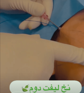 نمونه لیفت صورت با نخ دکتر سحر مروج