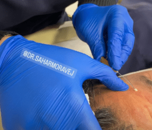 نمونه لیفت صورت با نخ دکتر سحر مروج