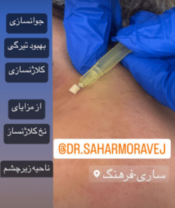 نمونه لیفت صورت با نخ دکتر سحر مروج