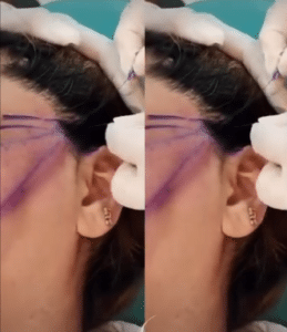 نمونه لیفت نخ کلینیک زیبایی برنا