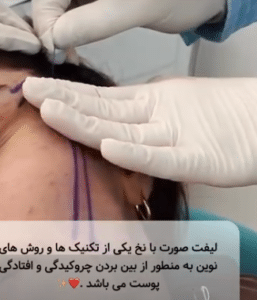 نمونه لیفت نخ کلینیک زیبایی برنا