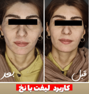 نمونه لیفت نخ کلینیک زیبایی برنا
