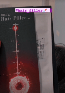 نمونه درمان ریزش م با هیرفیلر دکتر محسن پورآریا