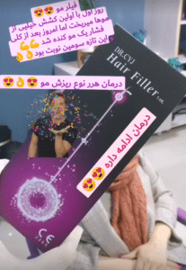 نمونه درمان ریزش م با هیرفیلر دکتر محسن پورآریا