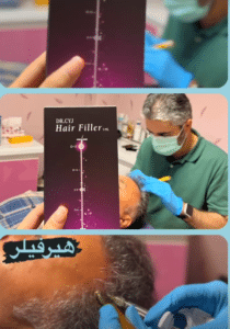 نمونه درمان ریزش مو با هیرفیلر دکتر صادق هاشمی نسب