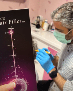 نمونه درمان ریزش مو با هیرفیلر دکتر صادق هاشمی نسب