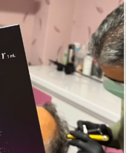 نمونه درمان ریزش مو با هیرفیلر دکتر صادق هاشمی نسب