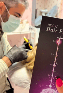 نمونه درمان ریزش مو با هیرفیلر دکتر صادق هاشمی نسب