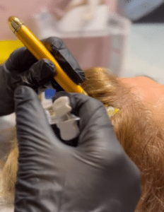 نمونه درمان ریزش مو با هیرفیلر دکتر صادق هاشمی نسب